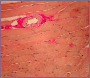 МЫШЕЧНАЯ ТКАНЬ ?В ЗОНЕ ИНЪЕКЦИИ АЛЛОГЕННОГО ГАП